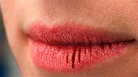 dudak kabuklanması neden olur
